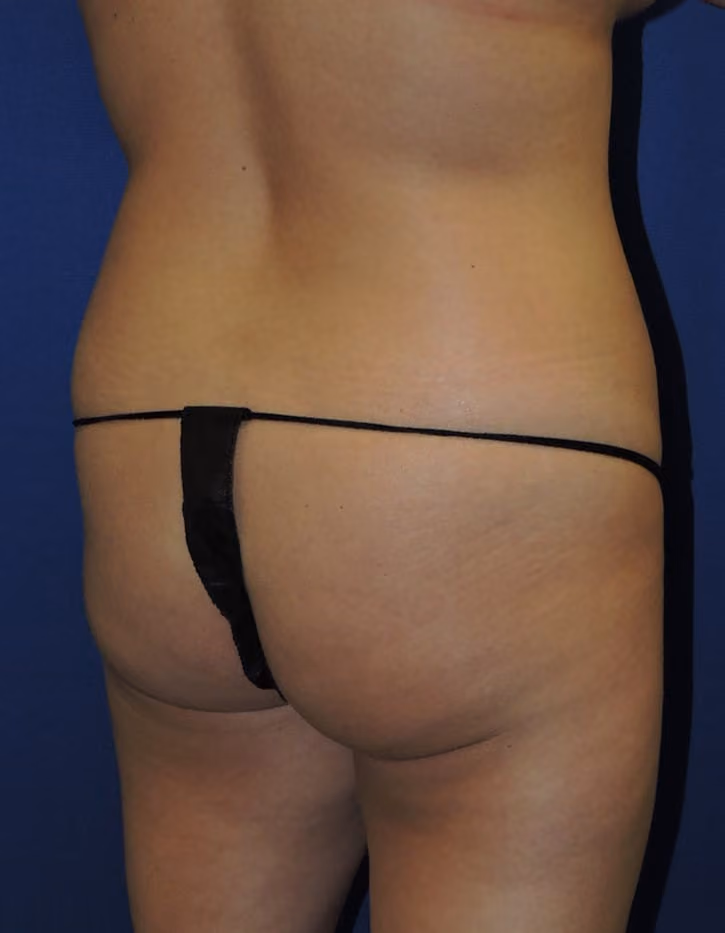 Brazilian Butt Lift before and after, case 8514 - Cool Springs Plastic Surgery