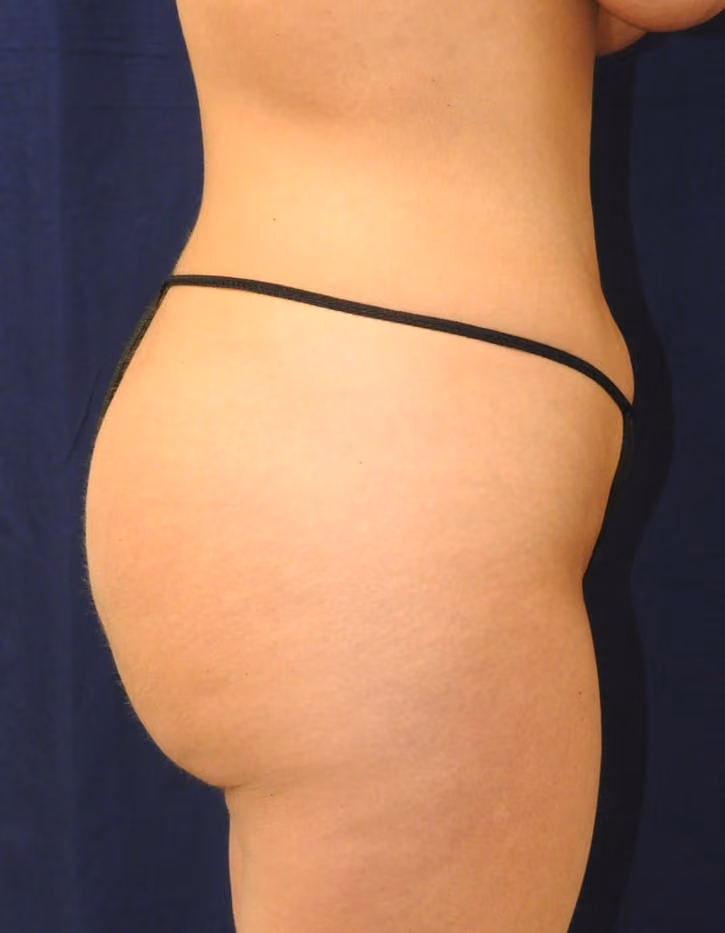Brazilian Butt Lift before and after, case 8514 - Cool Springs Plastic Surgery
