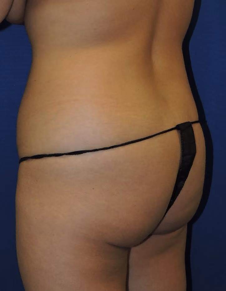 Brazilian Butt Lift before and after, case 8514 - Cool Springs Plastic Surgery