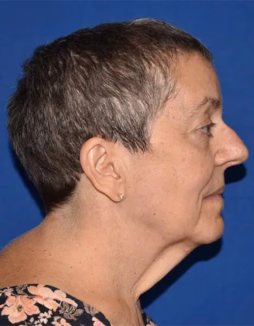 Facelift before and after, case 12959 - Cool Springs Plastic Surgery