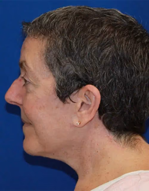 Facelift before and after, case 12959 - Cool Springs Plastic Surgery