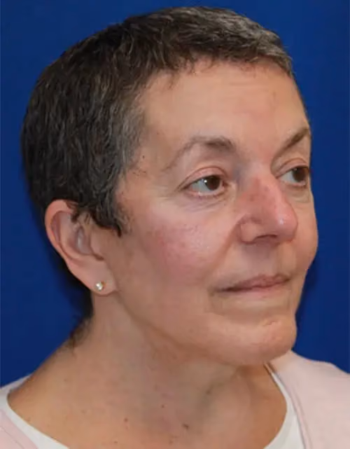 Facelift before and after, case 12959 - Cool Springs Plastic Surgery