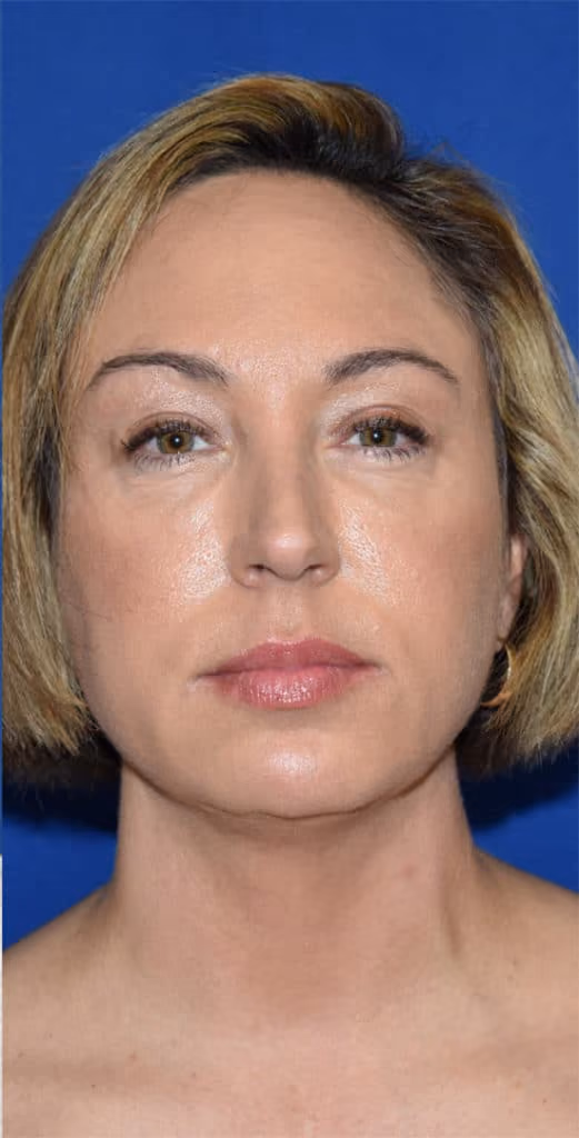 Liposuction before and after, Dr. Sarosiek, case 1915 - Cool Springs Plastic Surgery