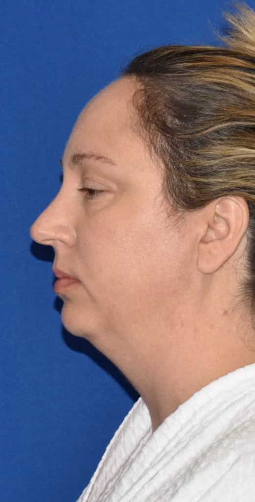 Liposuction before and after, Dr. Sarosiek, case 1915 - Cool Springs Plastic Surgery