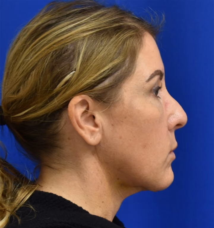 Liposuction before and after, case 2005 - Cool Springs Plastic Surgery