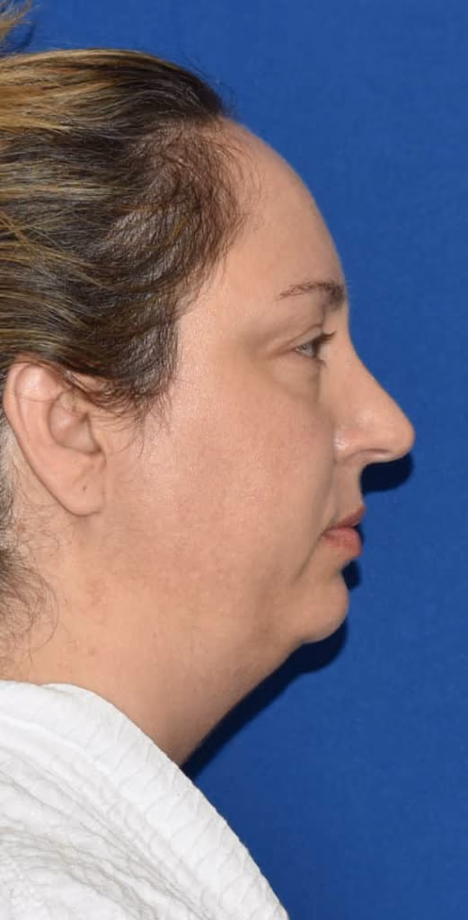 Liposuction before and after, Dr. Sarosiek, case 1915 - Cool Springs Plastic Surgery