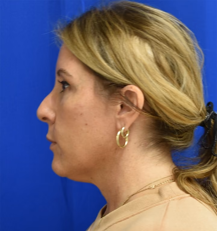 Liposuction before and after, case 2005 - Cool Springs Plastic Surgery