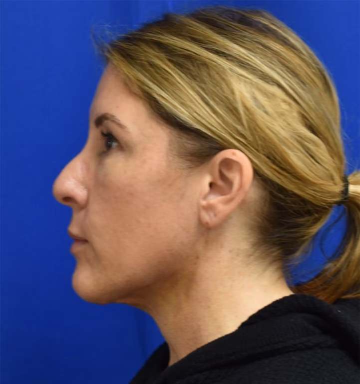 Liposuction before and after, case 2005 - Cool Springs Plastic Surgery