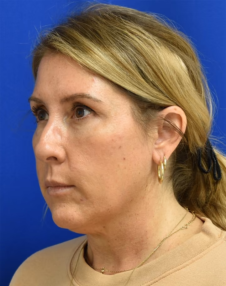 Liposuction before and after, case 2005 - Cool Springs Plastic Surgery