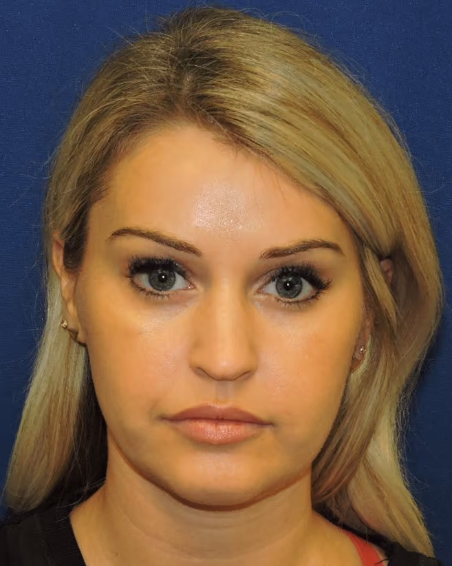 Liposuction before and after, case 2127 - Cool Springs Plastic Surgery