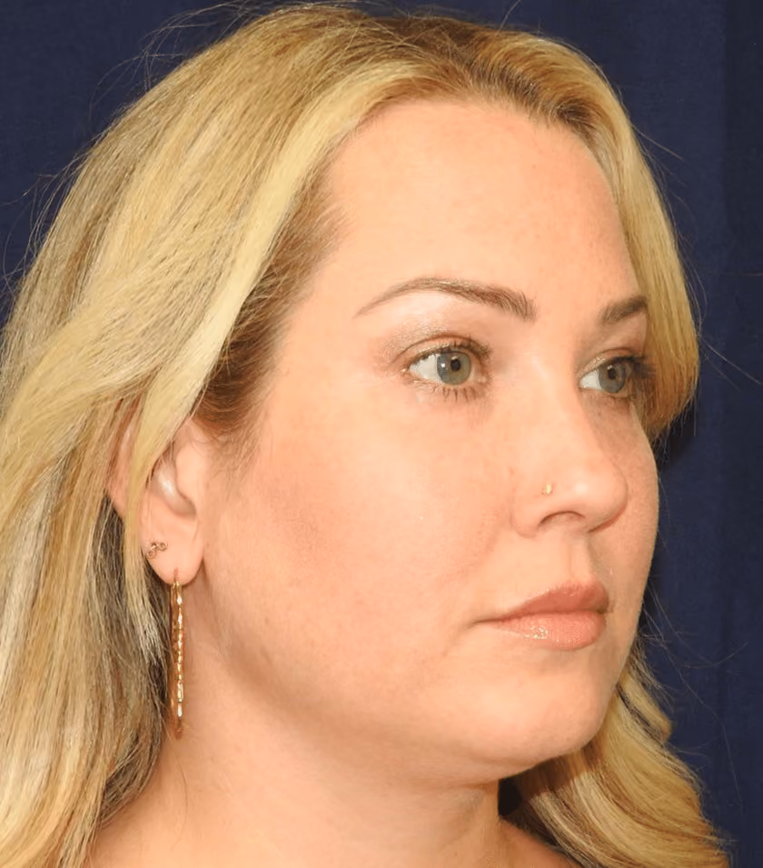 Liposuction before and after, case 2334 - Cool Springs Plastic Surgery