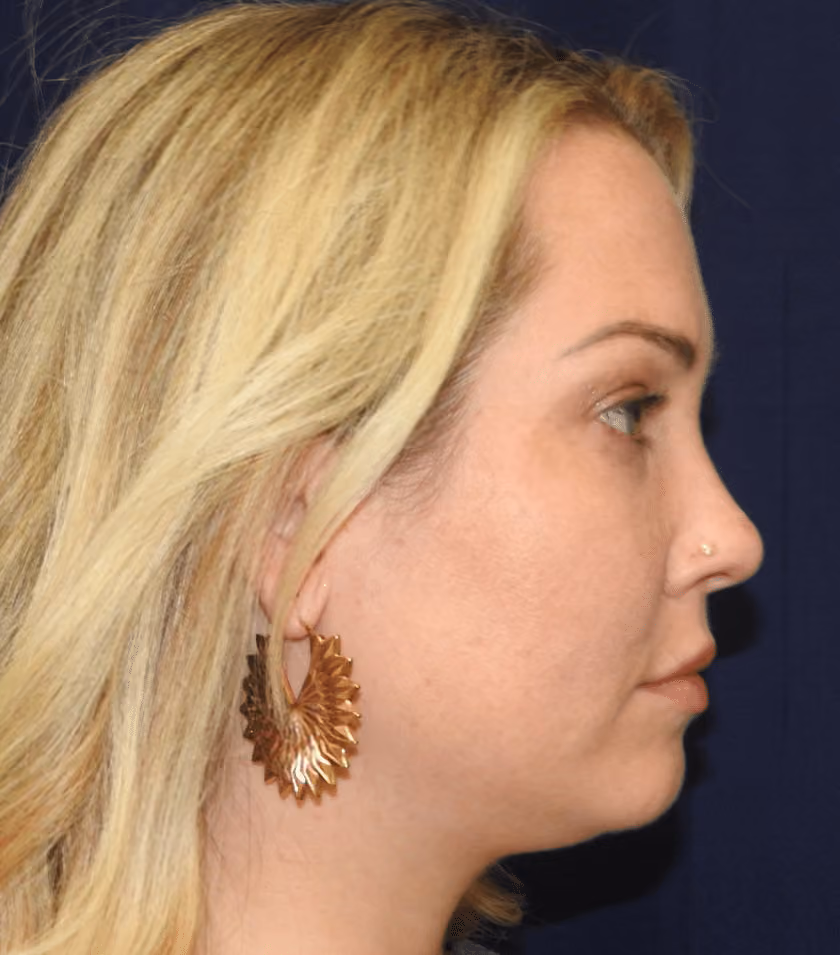 Liposuction before and after, case 2334 - Cool Springs Plastic Surgery