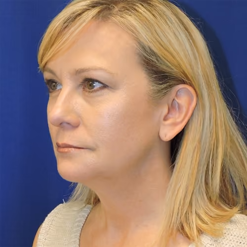 Liposuction before and after, case 2389 - Cool Springs Plastic Surgery