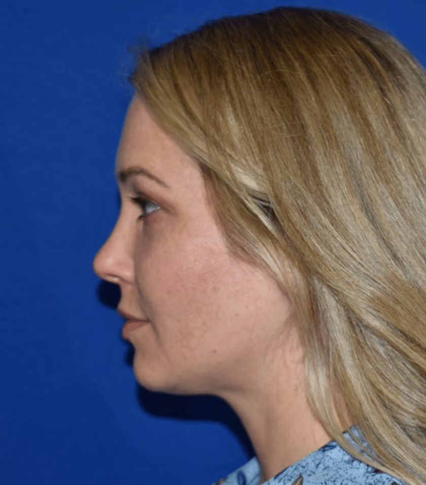 Liposuction before and after, case 2334 - Cool Springs Plastic Surgery
