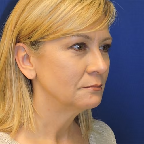 Liposuction before and after, case 2389 - Cool Springs Plastic Surgery