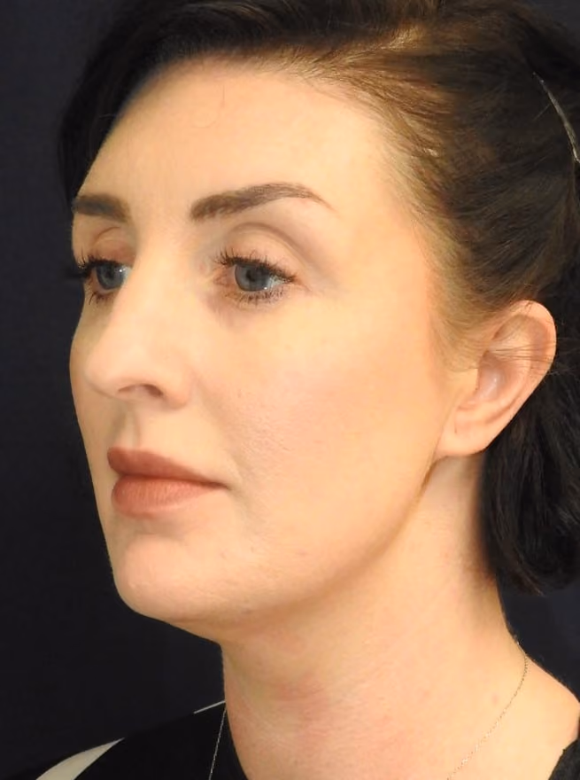 Liposuction before and after, case 2448 - Cool Springs Plastic Surgery