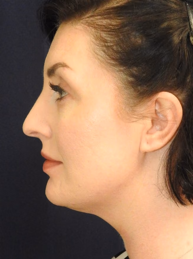 Liposuction before and after, case 2448 - Cool Springs Plastic Surgery