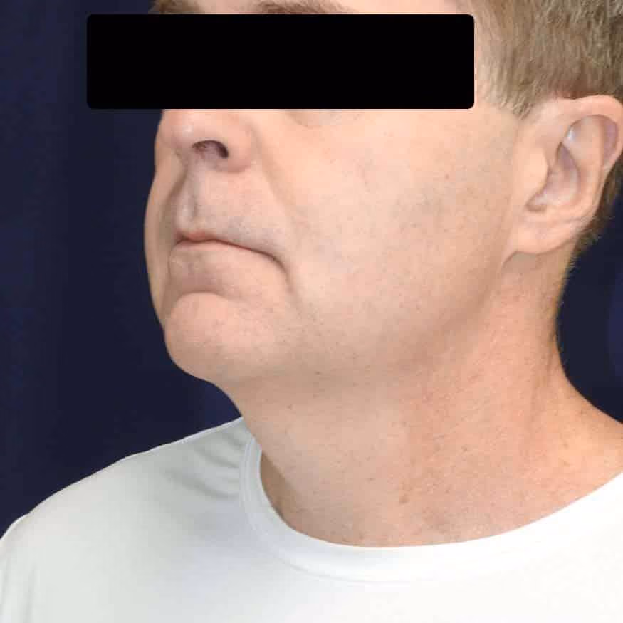Liposuction before and after, case 2659 - Cool Springs Plastic Surgery
