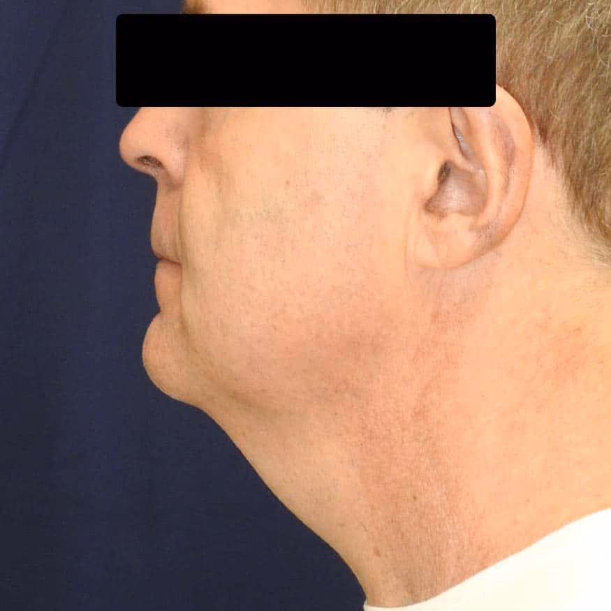 Liposuction before and after, case 2659 - Cool Springs Plastic Surgery