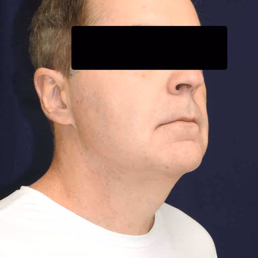 Liposuction before and after, case 2659 - Cool Springs Plastic Surgery