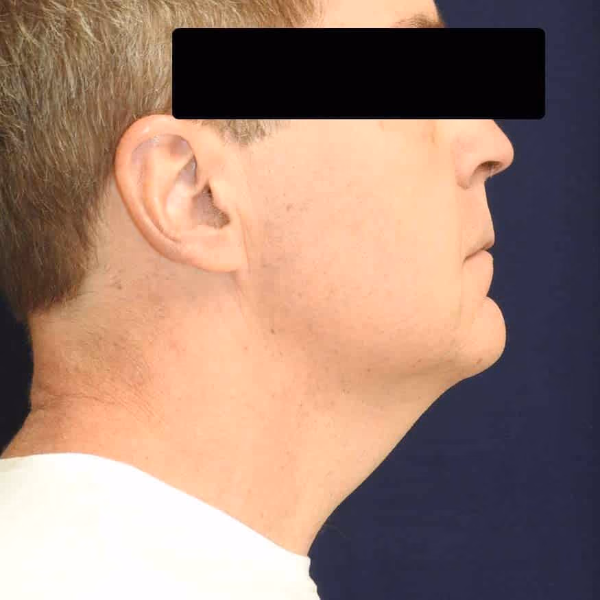 Liposuction before and after, case 2659 - Cool Springs Plastic Surgery