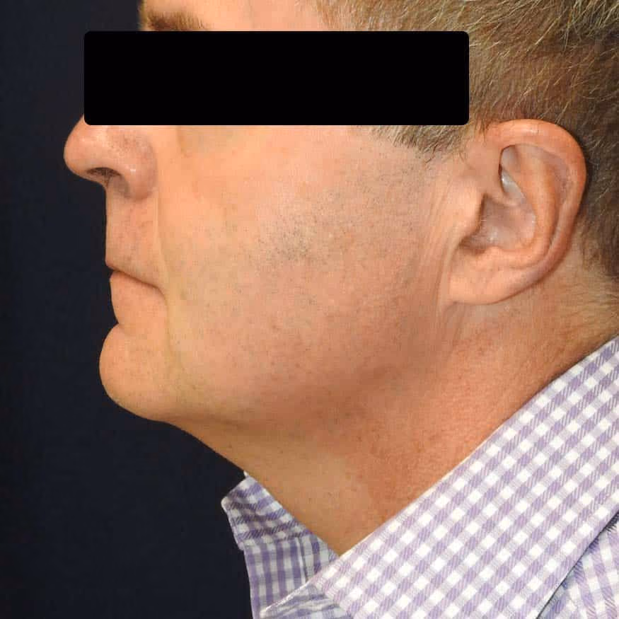 Liposuction before and after, case 2659 - Cool Springs Plastic Surgery
