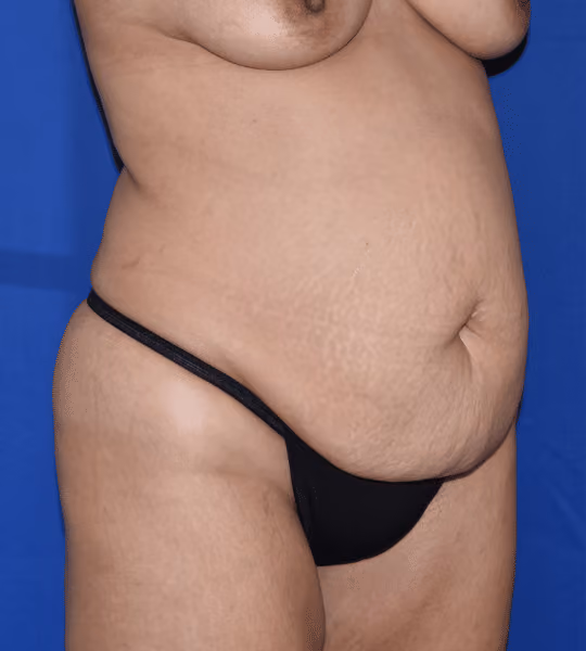 Tummy Tuck before and after, Dr. Sarosiek, case 6330 - Cool Springs Plastic Surgery