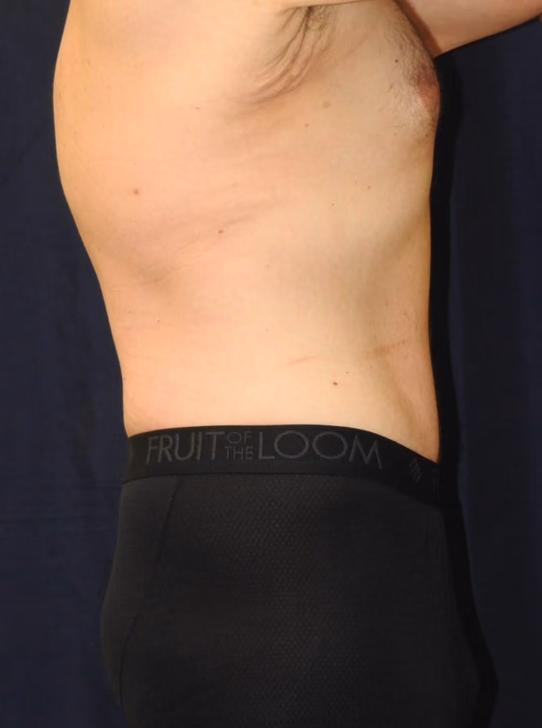 Tummy Tuck before and after, case 6474 - Cool Springs Plastic Surgery