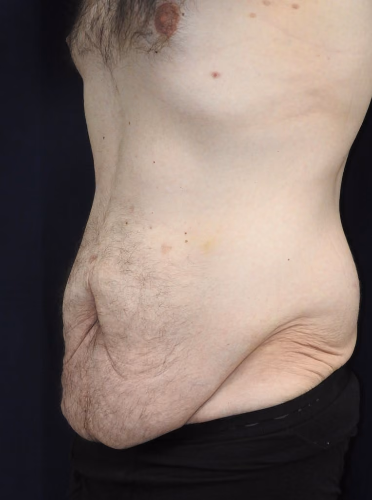 Tummy Tuck before and after, case 6474 - Cool Springs Plastic Surgery