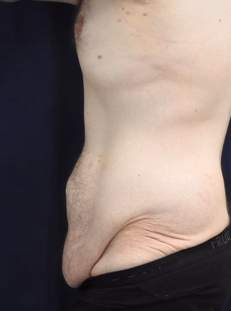 Tummy Tuck before and after, case 6474 - Cool Springs Plastic Surgery