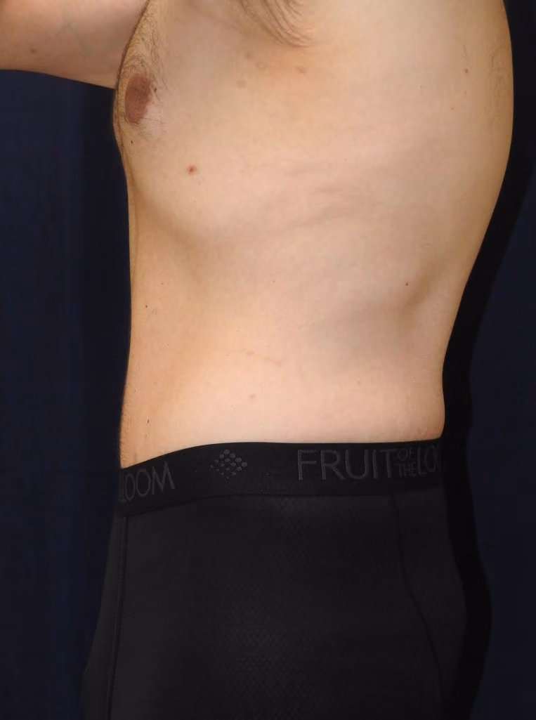 Tummy Tuck before and after, case 6474 - Cool Springs Plastic Surgery