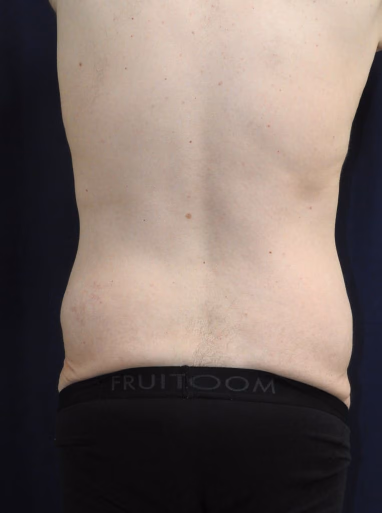 Tummy Tuck before and after, case 6474 - Cool Springs Plastic Surgery