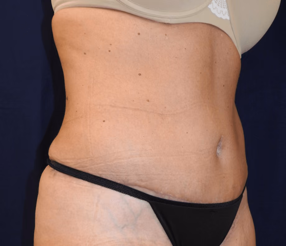 Tummy Tuck before and after, case 6606 - Cool Springs Plastic Surgery