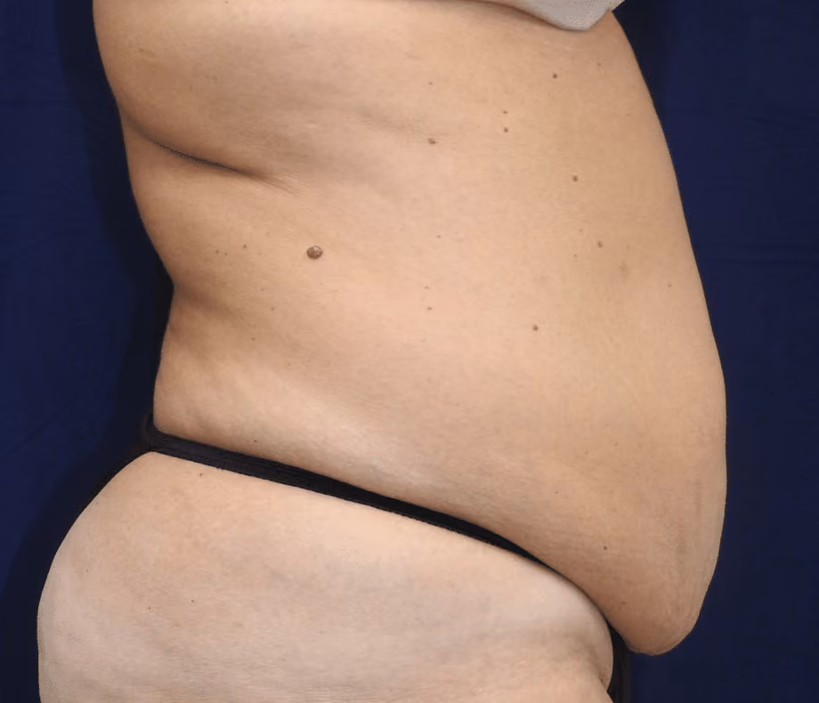 Tummy Tuck before and after, case 6606 - Cool Springs Plastic Surgery