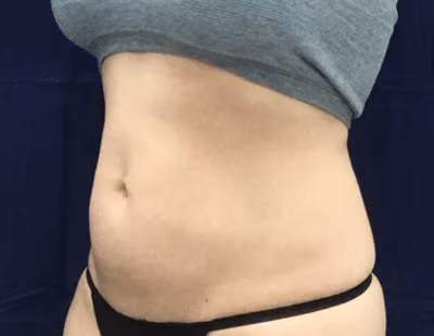 Liposuction before and after, case 6801 - Cool Springs Plastic Surgery
