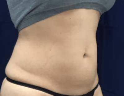 Liposuction before and after, case 6801 - Cool Springs Plastic Surgery