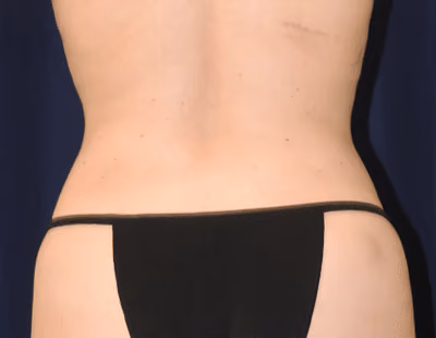 Liposuction before and after, case 6801 - Cool Springs Plastic Surgery