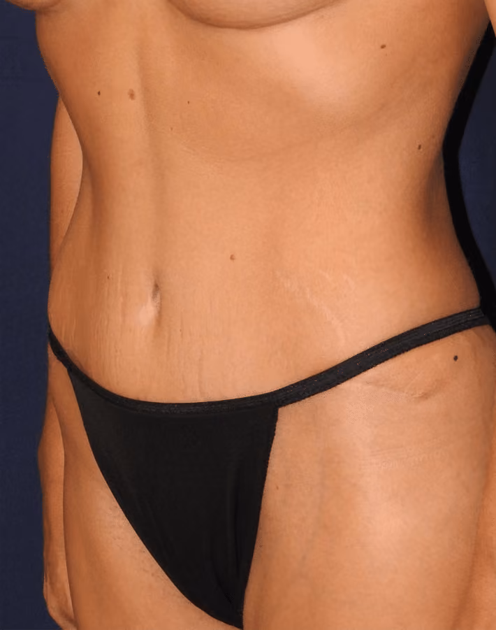 Tummy Tuck before and after, case 7029 - Cool Springs Plastic Surgery