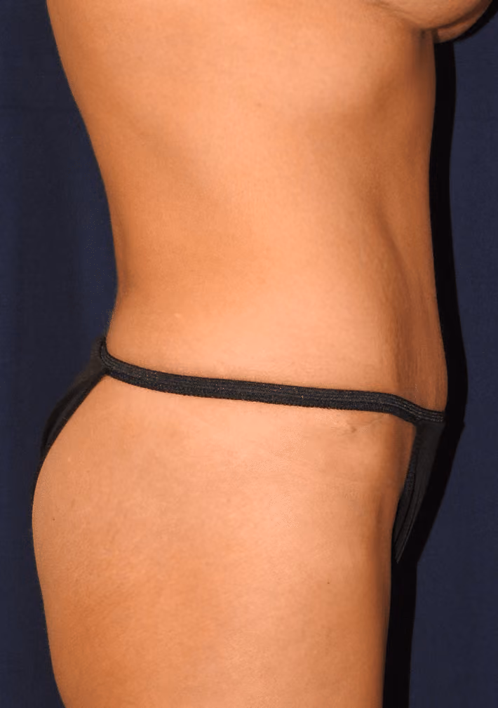Tummy Tuck before and after, case 7029 - Cool Springs Plastic Surgery