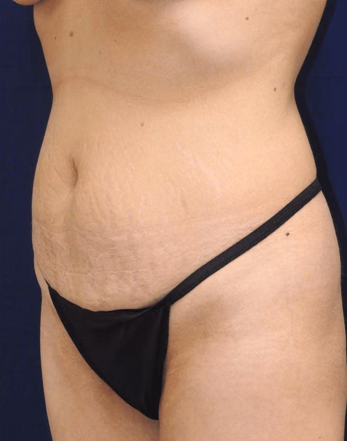 Tummy Tuck before and after, case 7029 - Cool Springs Plastic Surgery