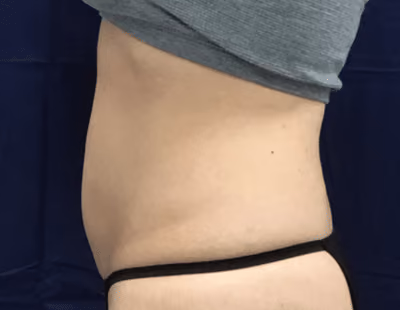 Liposuction before and after, case 6801 - Cool Springs Plastic Surgery