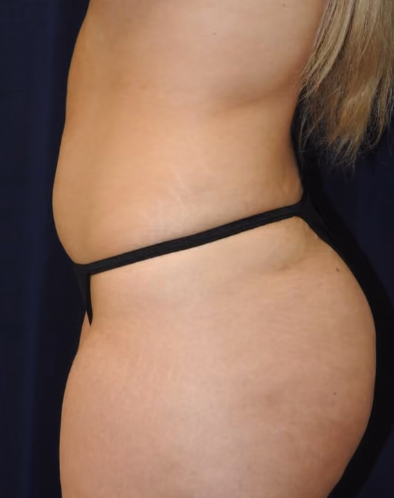 Liposuction before and after, case 7130 - Cool Springs Plastic Surgery