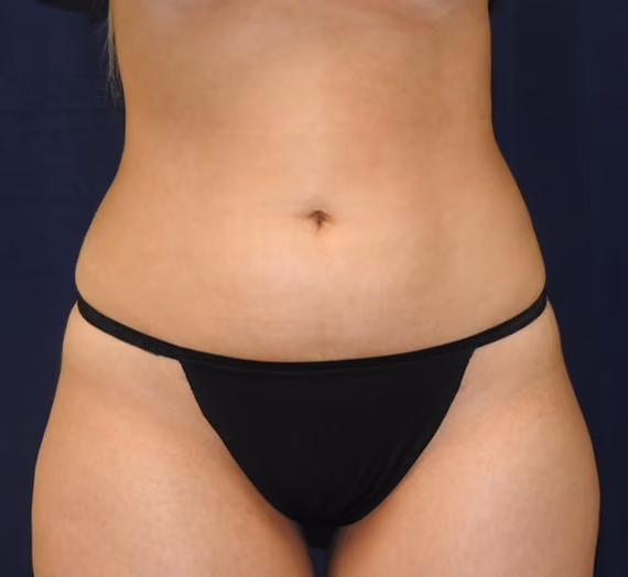 Liposuction before and after, case 7130 - Cool Springs Plastic Surgery