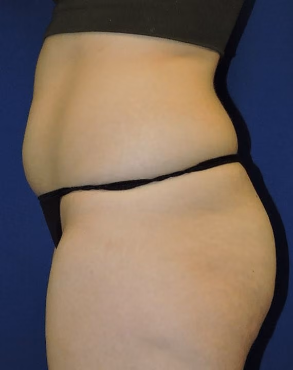 Liposuction before and after, case 7130 - Cool Springs Plastic Surgery