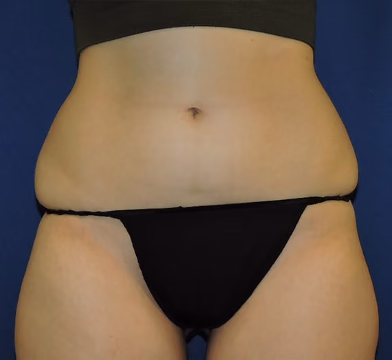 Liposuction before and after, case 7130 - Cool Springs Plastic Surgery