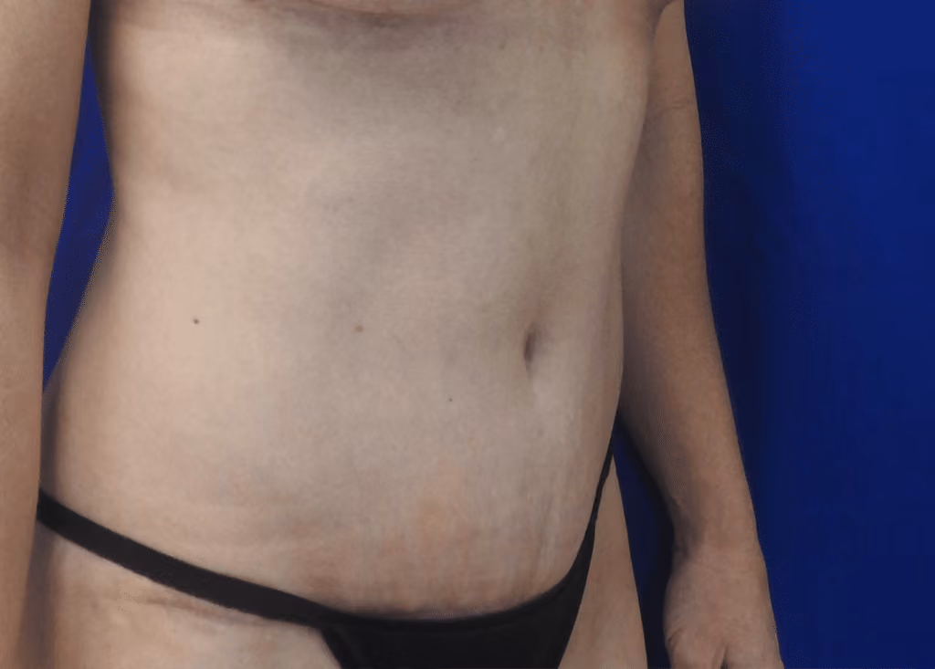 Tummy Tuck before and after, case 7154 - Cool Springs Plastic Surgery