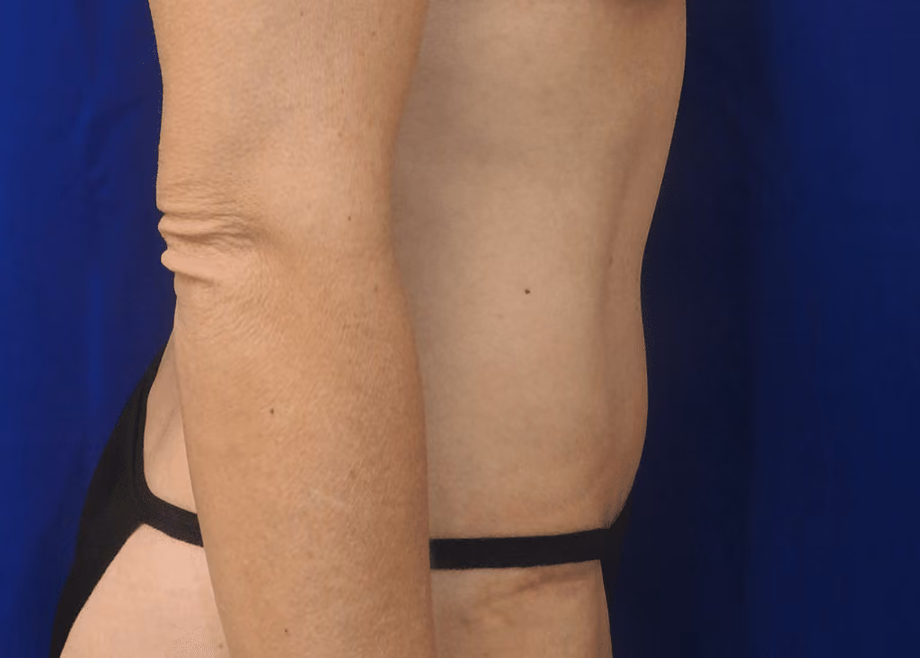 Tummy Tuck before and after, case 7154 - Cool Springs Plastic Surgery
