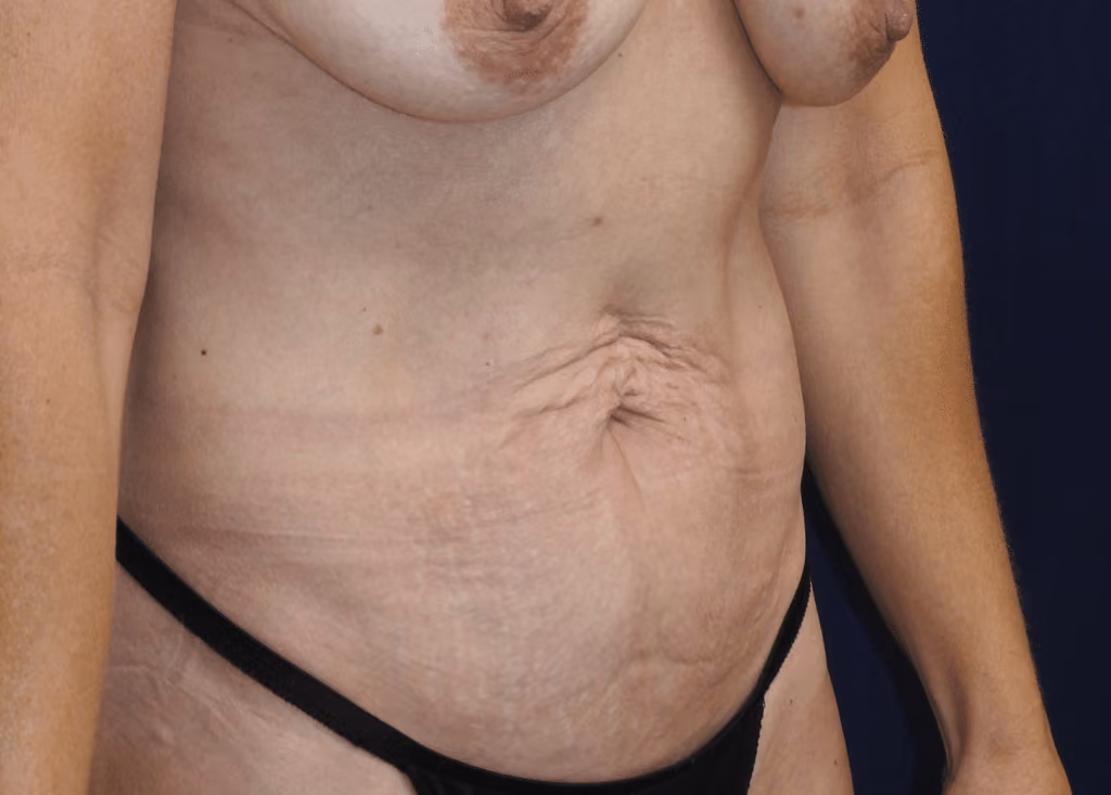 Tummy Tuck before and after, case 7154 - Cool Springs Plastic Surgery