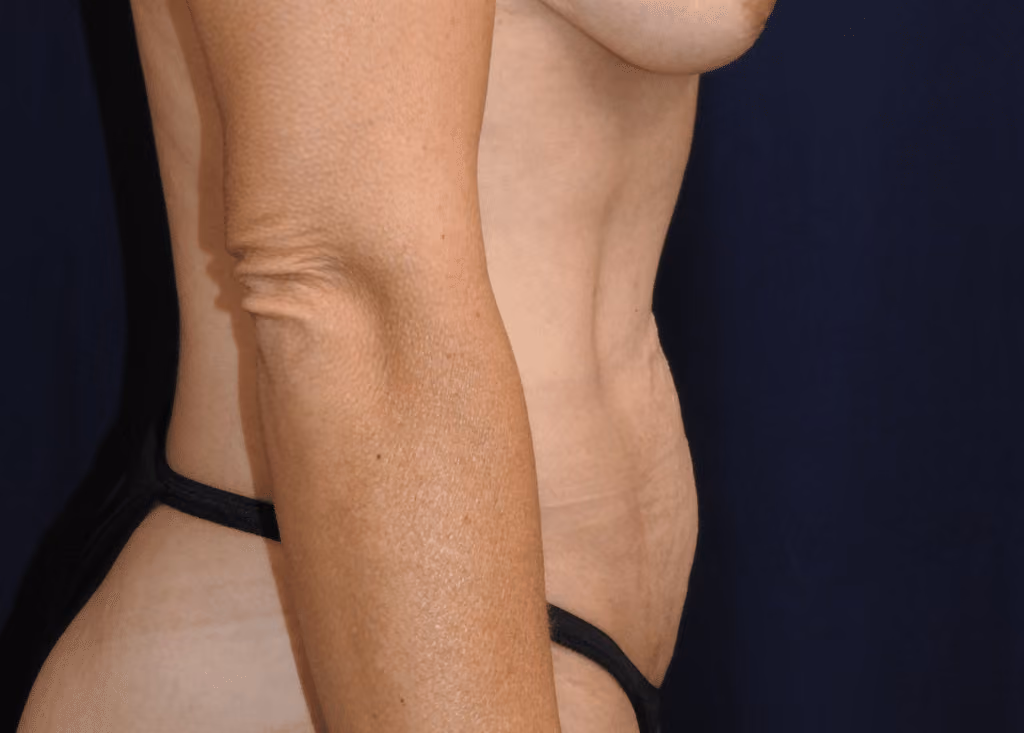 Tummy Tuck before and after, case 7154 - Cool Springs Plastic Surgery