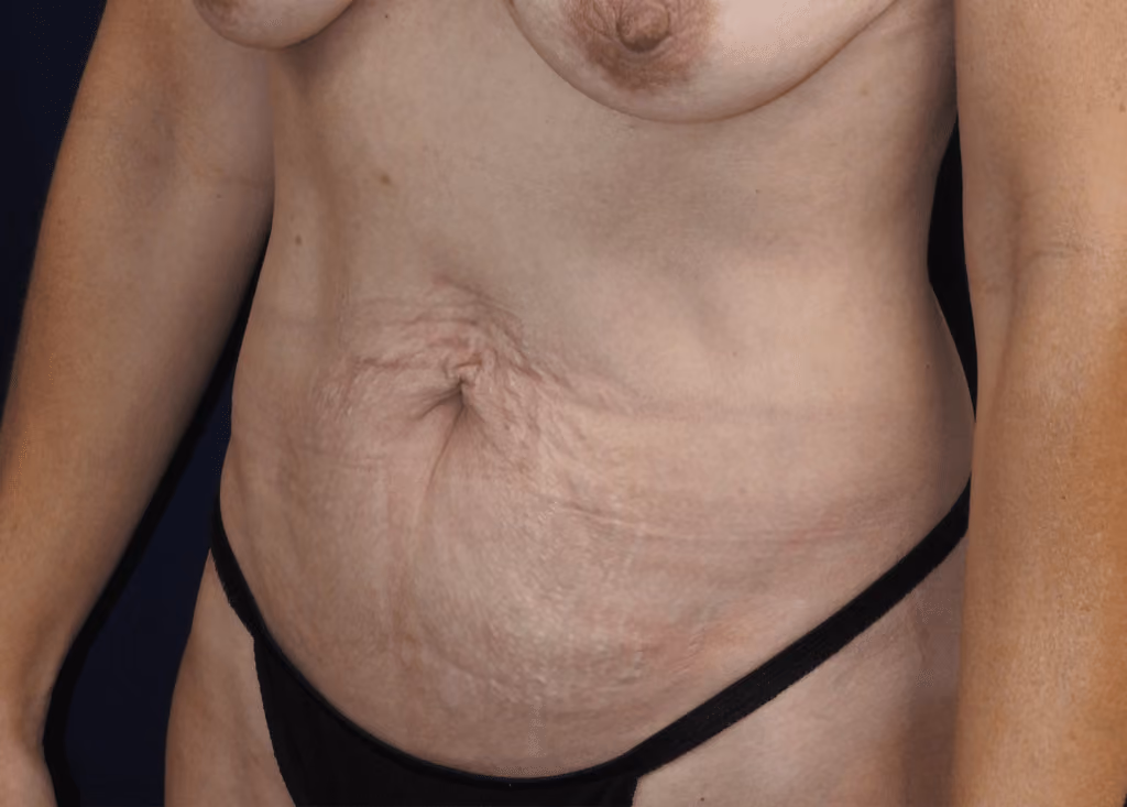 Tummy Tuck before and after, case 7154 - Cool Springs Plastic Surgery